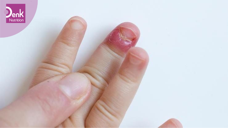 Tóc, móng giòn, dễ gãy
