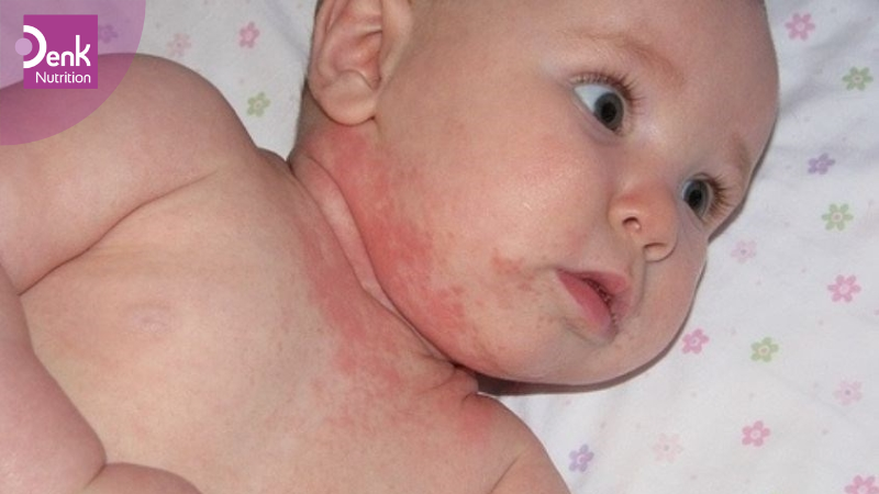 Nguyên nhân trẻ dị ứng với đạm trong sữa công thức