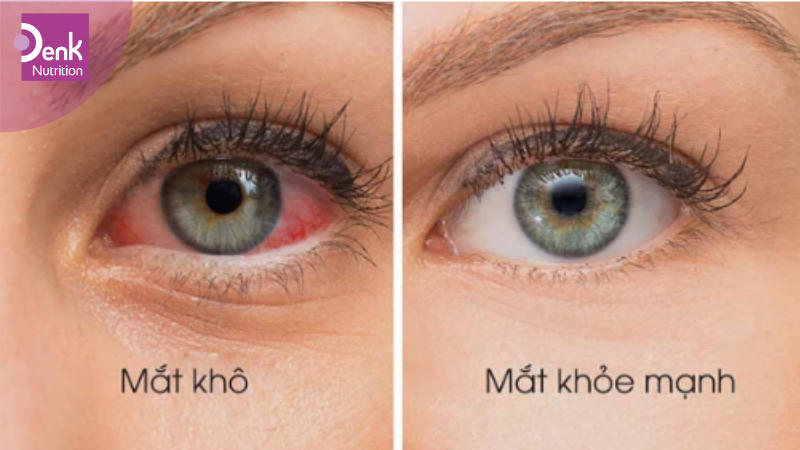 Giảm khô mắt
