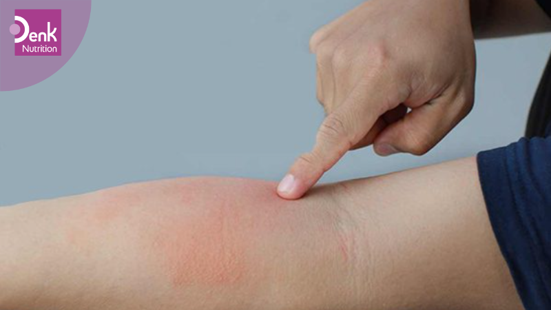 Người có cơ địa dị ứng Omega