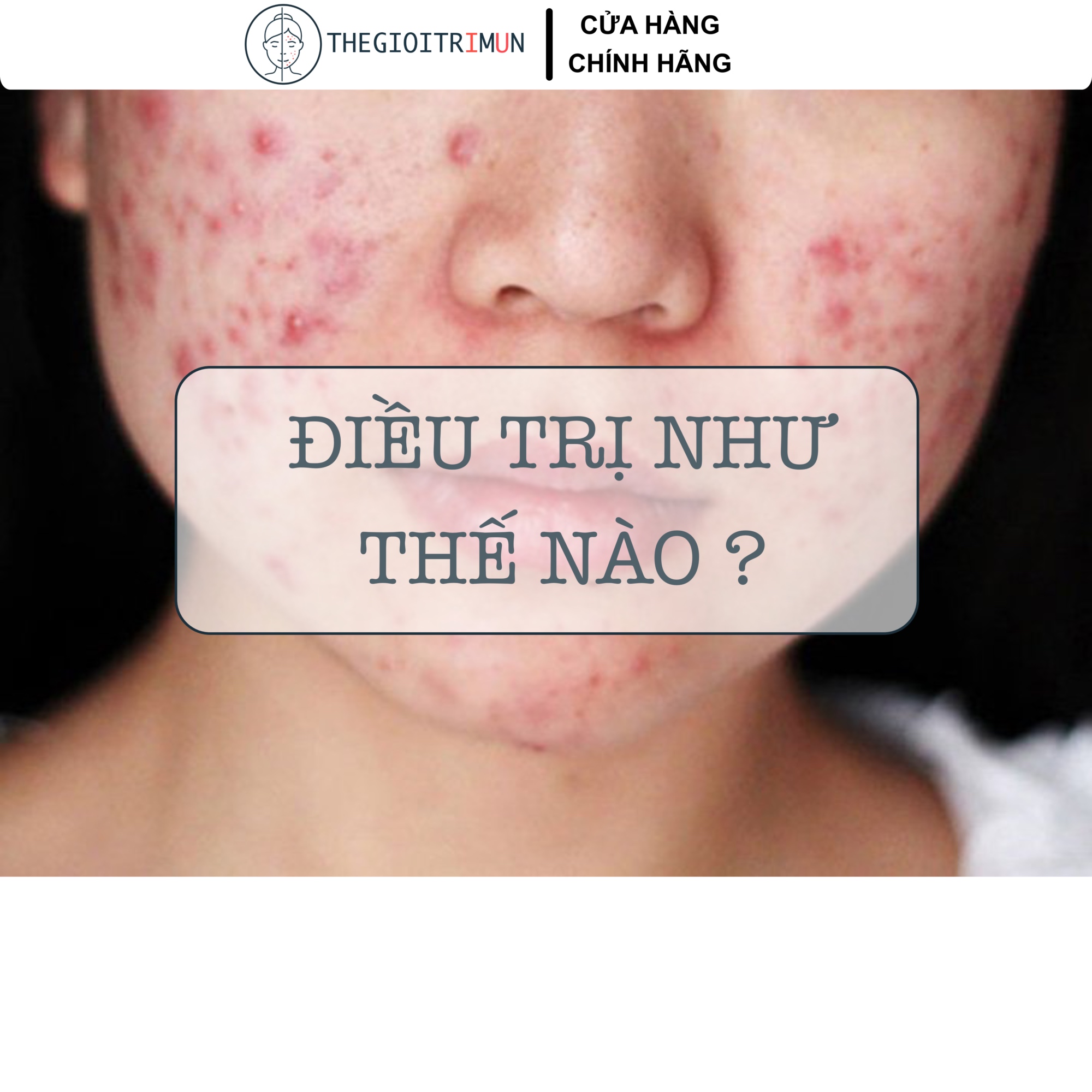 Điều trị mụn trứng cá