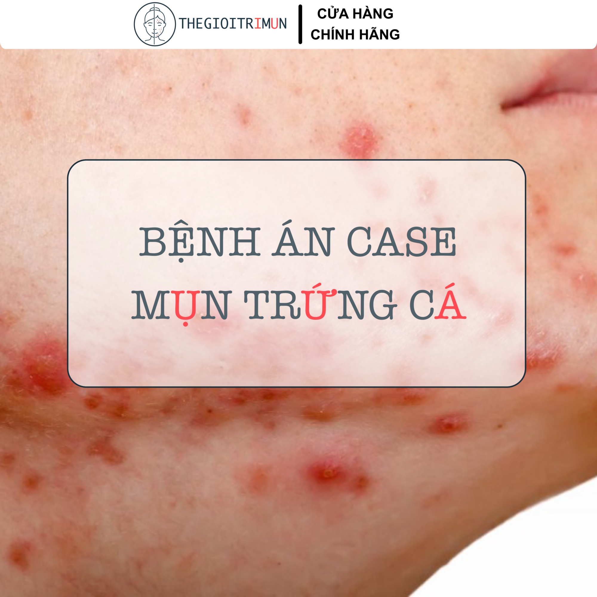 Case lâm sàng mụn trứng cá