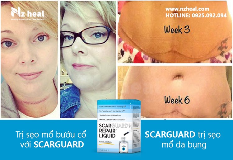 Gel Trị Sẹo Lồi Scarguard Repair Liquid 15ml (Scarguard MD)