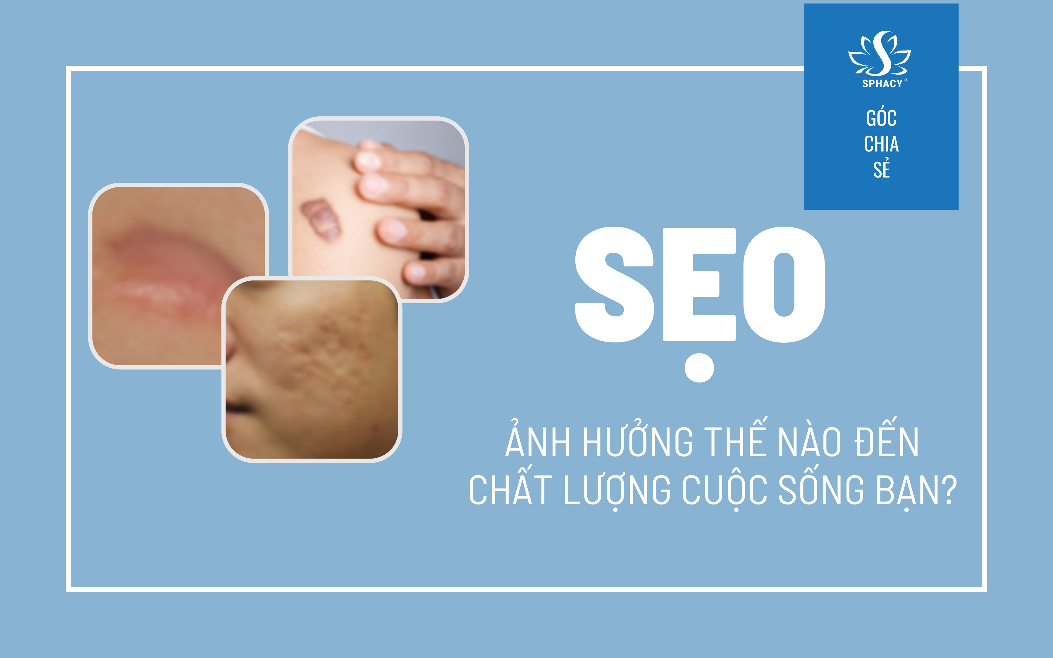 SẸO LỒI, SẸO PHÌ ĐẠI, SẸO MỤN - ẢNH HƯỞNG VÀ CÁCH GIẢI QUYẾT SẸO LỒI, SẸO PHÌ ĐẠI, SẸO MỤN - ẢNH HƯỞNG VÀ CÁCH GIẢI QUYẾT