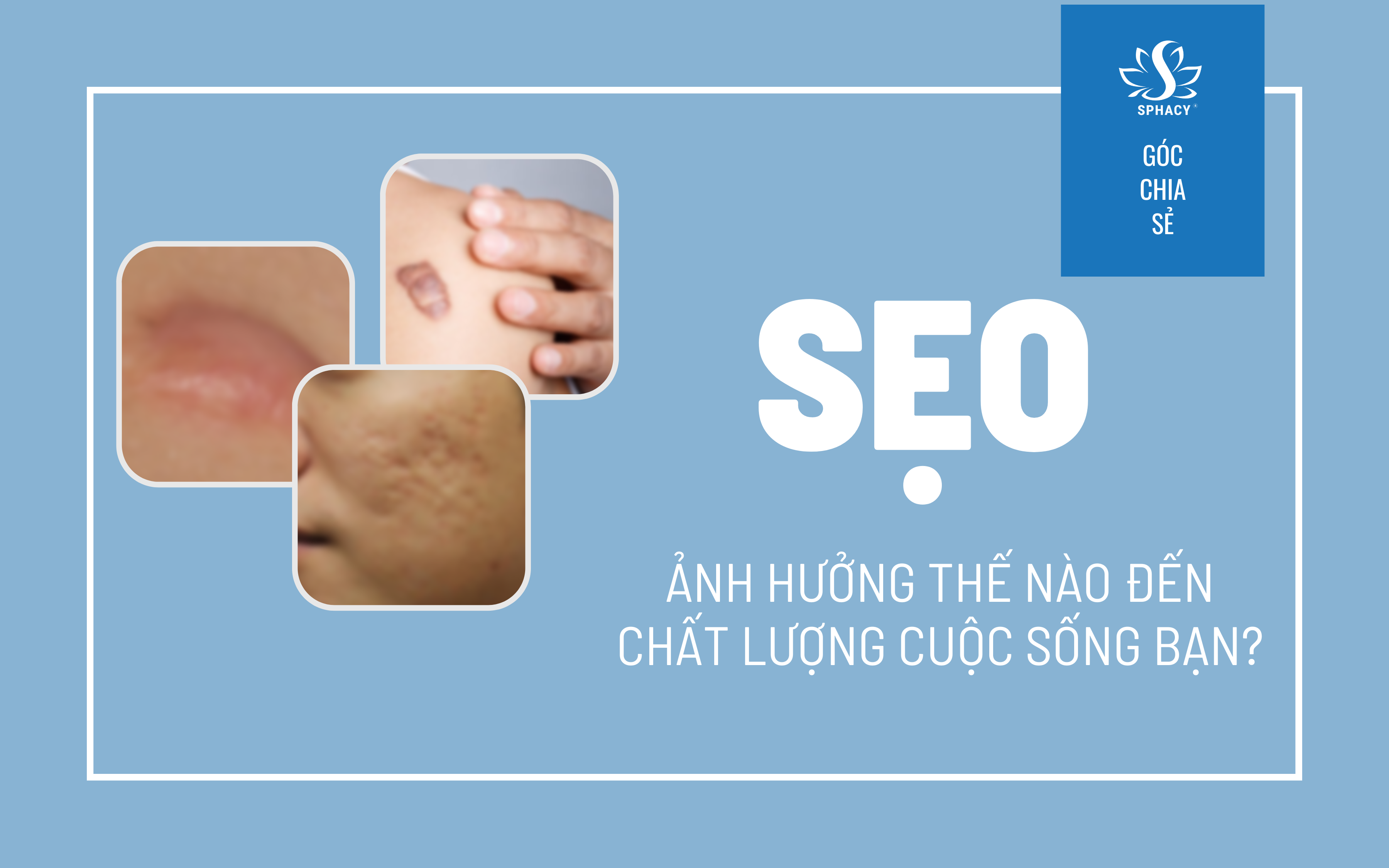 SẸO LỒI, SẸO PHÌ ĐẠI, SẸO MỤN - ẢNH HƯỞNG VÀ CÁCH GIẢI QUYẾT