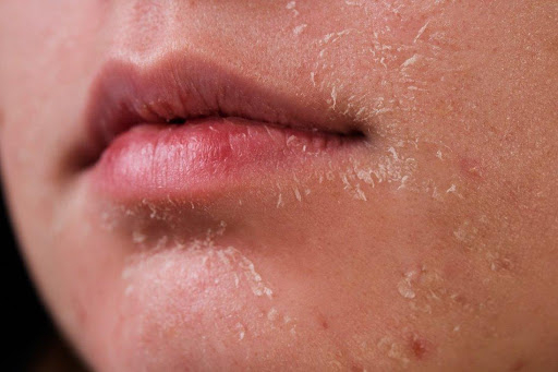 Nguyên nhân và biểu hiện da của bạn bị khô