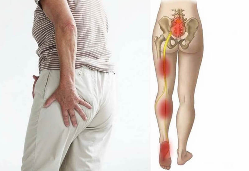 Đau thần kinh tọa: Nguyên nhân, triệu chứng và điều trị