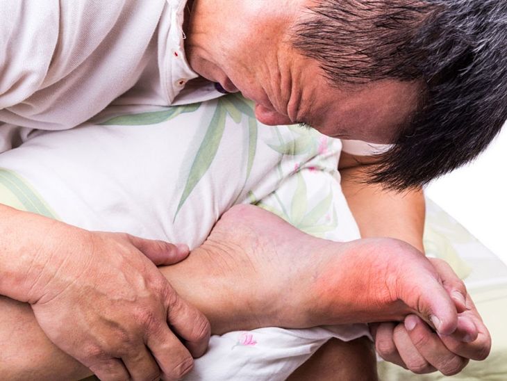 Tại sao tỷ lệ nam giới mắc bệnh Gút (Gout) lại nhiều hơn nữ giới?