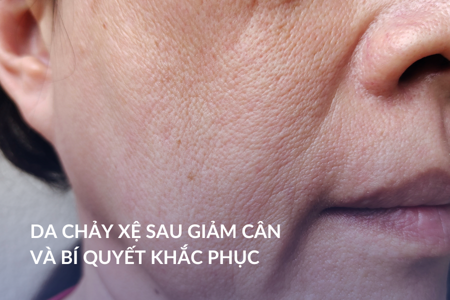 Da chảy xệ sau giảm cân và bí quyết khắc phục