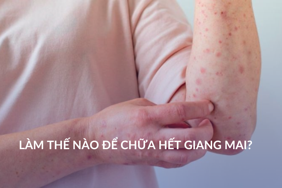 Làm thế nào để chữa hết giang mai?