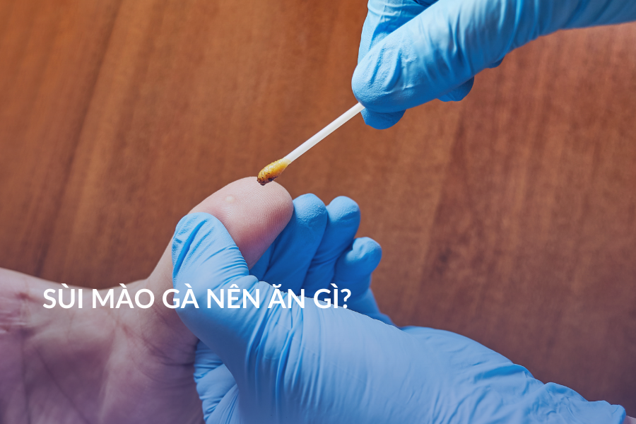 Sùi mào gà nên ăn gì?