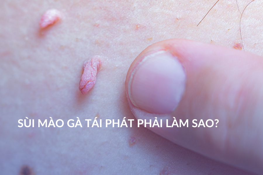 Sùi mào gà tái phát phải làm sao?