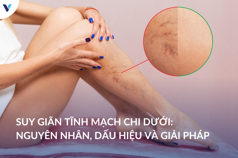 Suy giãn tĩnh mạch chi dưới: Nguyên nhân, dấu hiệu và giải pháp