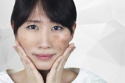 Phân biệt nám da và tàn nhang