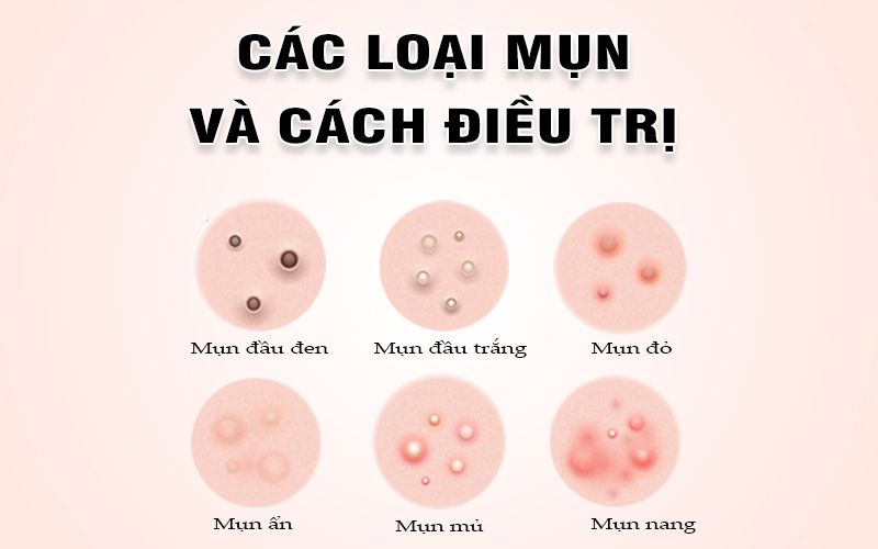 CÁC LOẠI MỤN KHÁC NHAU VÀ CÁCH ĐIỀU TRỊ