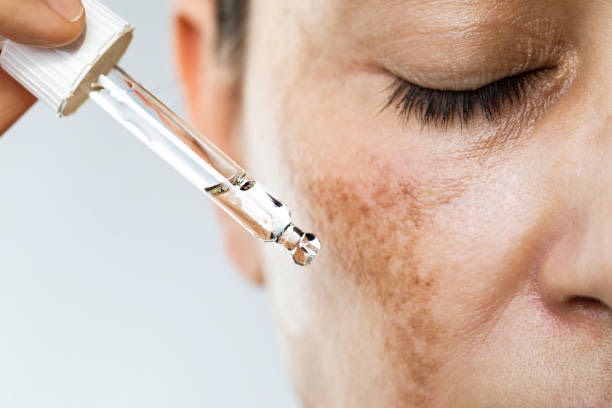 NGUYÊN NHÂN DẪN TỚI NÁM NỘI TIẾT CỦA PHỤ NỮ