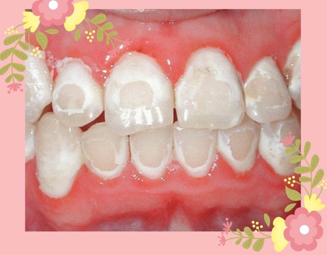 Bề mặt răng bé bị sần đốm trắng: nguyên nhân, biểu hiện và cách khắc phục