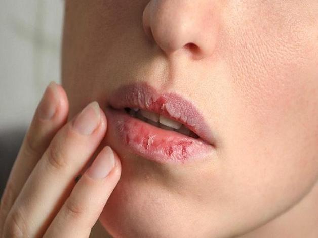 Cách điều trị khô miệng tại nhà hiệu quả