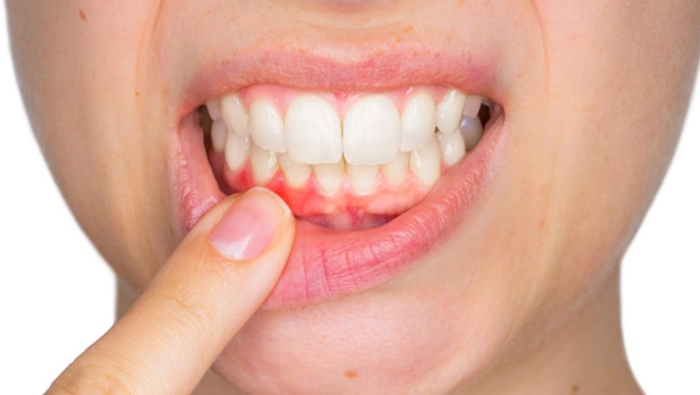 Gingivitis: Causes, signs and prevention
