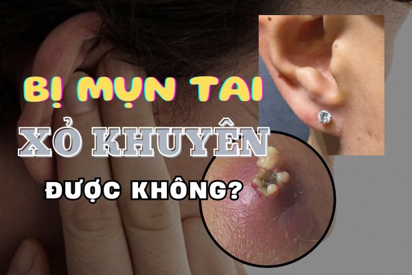 Bị mụn ở thịt tai có xỏ khuyên được không và mẹo bỏ túi