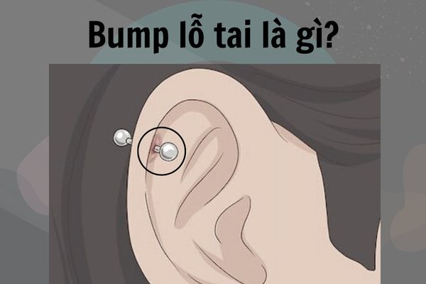 Bump lỗ tai (lỗ xỏ) là gì? Nguyên nhân & cách xử lí hiệu quả cho hội mê xỏ