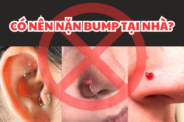 Có nên nặn bump tại nhà không? 3 lưu ý bạn nên biết