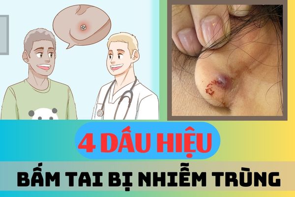4 dấu hiệu bấm lỗ tai bị nhiễm trùng - Cách chữa hiệu quả cho từng giai đoạn