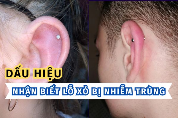 Dấu hiệu nhiễm trùng lỗ xỏ khuyên - Nguyên nhân & cách xử lí mà bạn nên biết