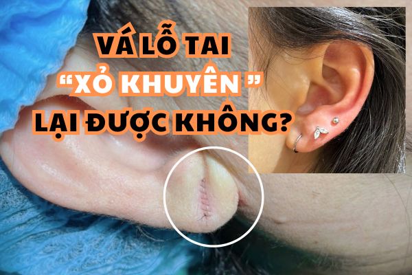 (Vá) Khâu lỗ tai có xỏ khuyên lại được không?