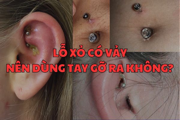 Lỗ xỏ khuyên có lớp vảy nên gỡ ra không? Mẹo xử lí hay ho
