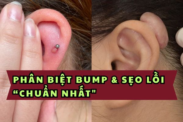 Phân biệt bump và sẹo lồi trong xỏ khuyên chuẩn nhất
