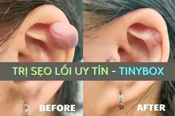 Trị sẹo lồi sau xỏ khuyên uy tín tại TpHCM - TinyBox