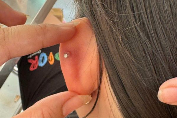 lỗ xỏ bị sưng đỏ có kèm theo nốt bump