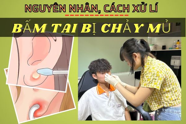 Bấm lỗ tai chảy mủ phải làm sao? Nguyên nhân & cách xử lí vô cùng hiệu quả
