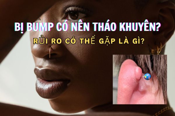 Bị bump có nên tháo khuyên không