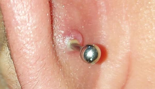 bị bump khi xỏ khuyên