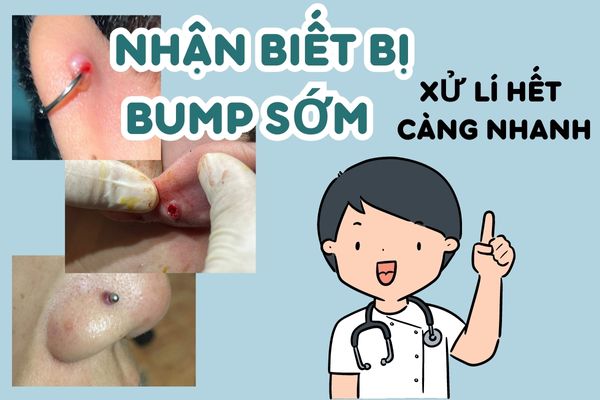 bị bump khi xỏ khuyên