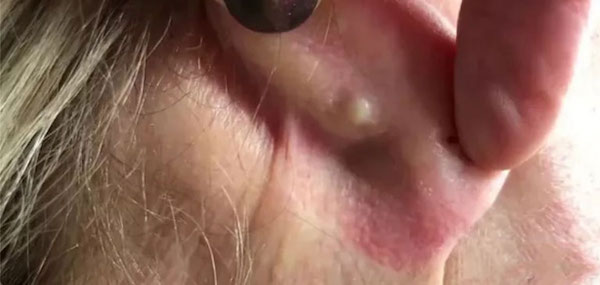 Bị mụn ở thịt tai có xỏ khuyên được không