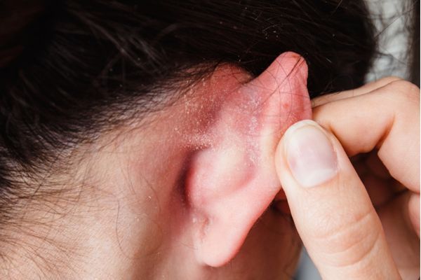 Các dấu hiệu bị dị ứng sau khi xỏ khuyên