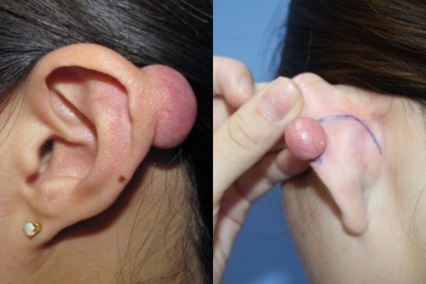 Hết đau vẫn cần "kỷ luật"! Cách chăm sóc lỗ xỏ tránh sẹo lồi