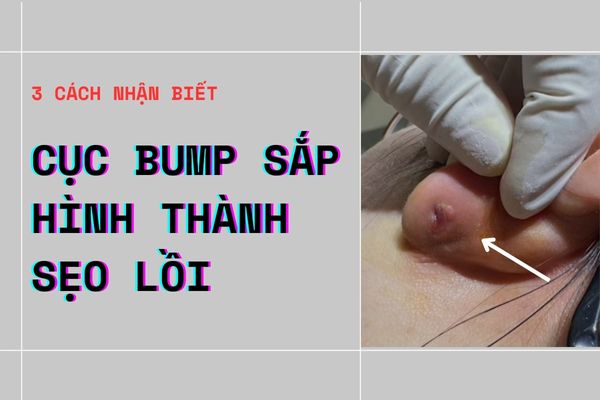 3 cách nhận biết bị bump sắp thành sẹo lồi trong xỏ khuyên