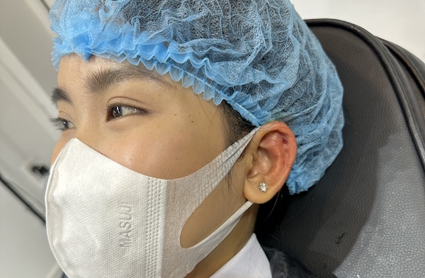 Cách xỏ khuyên thịt tai không bị ra máu