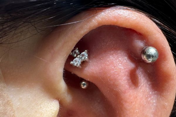 Cơ địa sẹo lồi xỏ khuyên được không