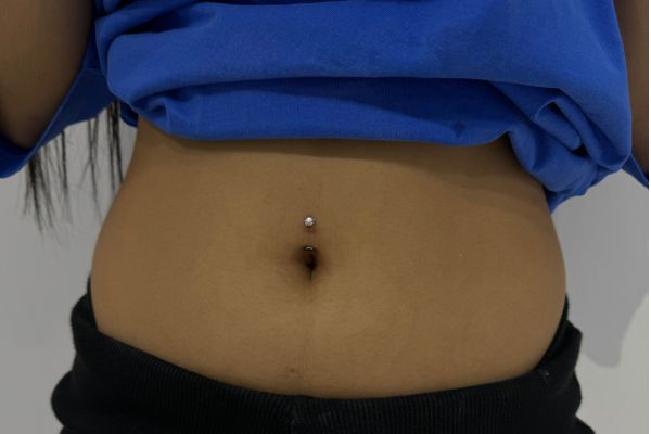 Cơ địa sẹo lồi xỏ khuyên được không