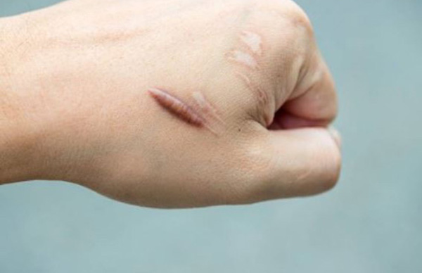 Cơ địa sẹo lồi xỏ khuyên được không