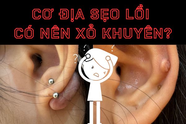 Cơ địa sẹo lồi xỏ khuyên được không
