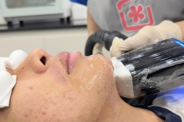 triệt lông cằm và mép ở tinybox