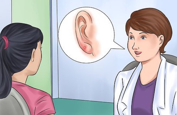 Dấu hiệu nhiễm trùng lỗ xỏ khuyên