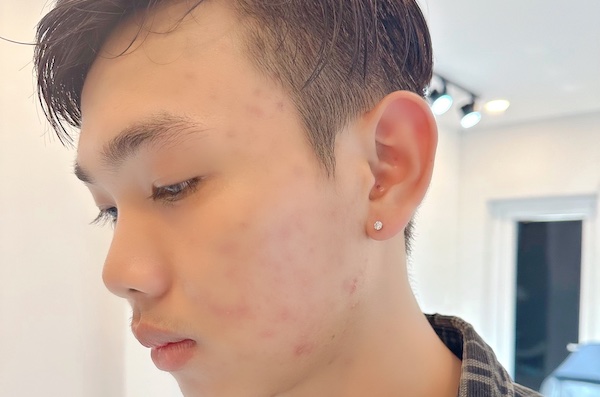 Hình ảnh xỏ khuyên tai nam - bấm lỗ tai nam