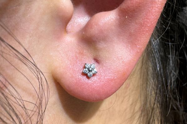 (Vá) Khâu lỗ tai có xỏ khuyên lại được không?